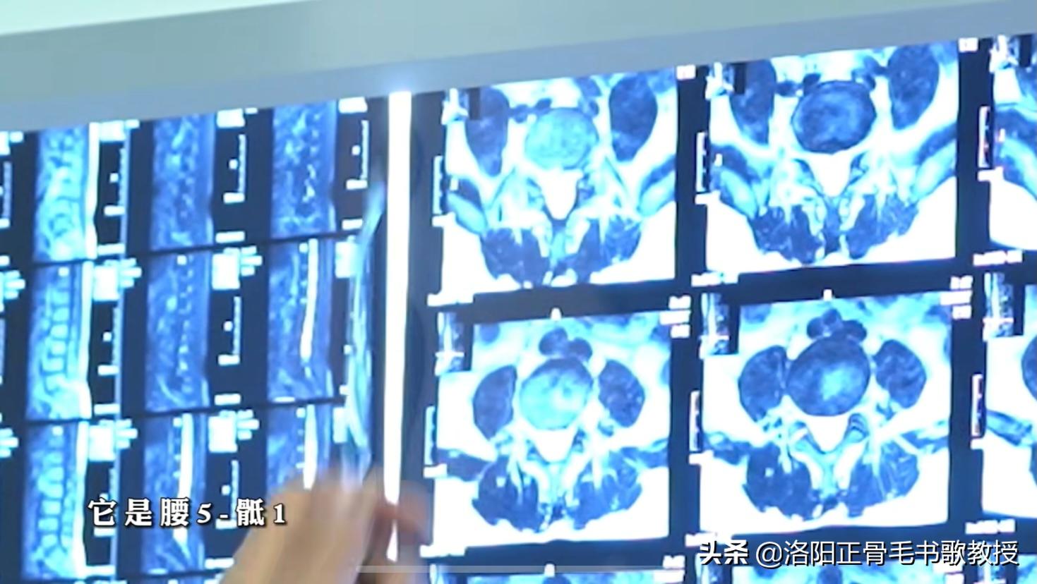 大爷腰间盘突出都治好了,腰间盘突出自愈患者讲述