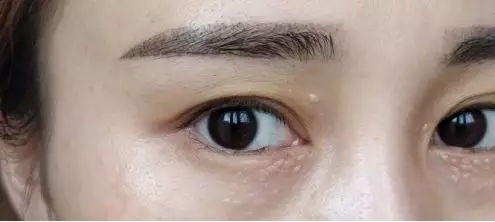 脸上莫名冒出白色小疙瘩,脸上出现奇怪的印子