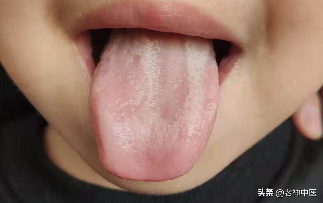 小孩子脾胃虚弱舌苔脱落怎么调理,儿童舌苔脱落如何食疗