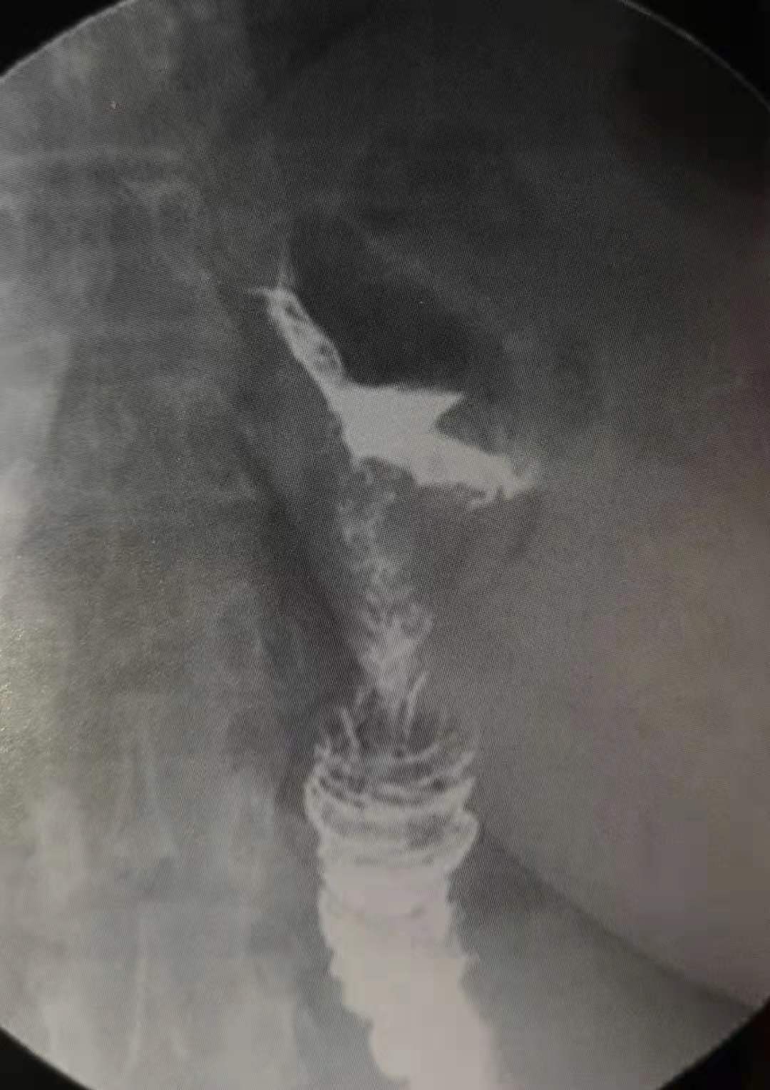 辟谣：每餐少吃点，胃就会缩小？医生说：缩胃手术减肥要谨慎