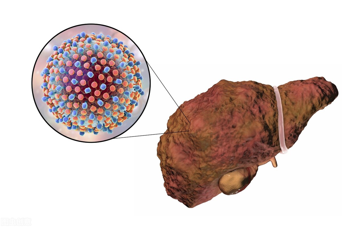 肝炎肝硬化肝癌的演变过程,乙肝肝硬化肝癌三部曲要吃什么药