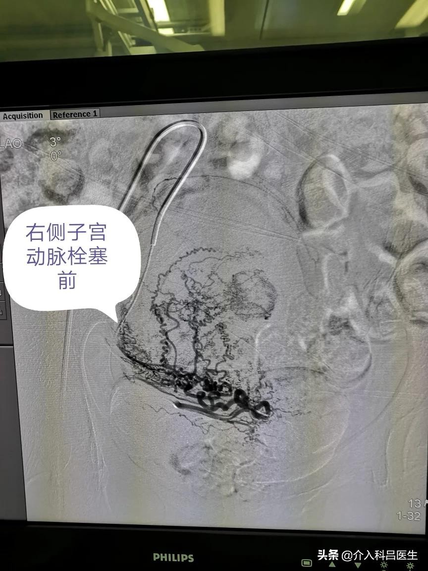 子宫肌瘤囊肿50岁手术风险,子宫肌瘤长在前壁42x32mm需要手术