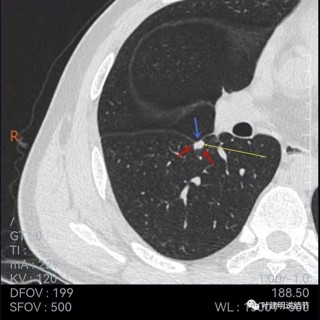 问诊分析：存在了4年的实性结节会不会是肺癌？
