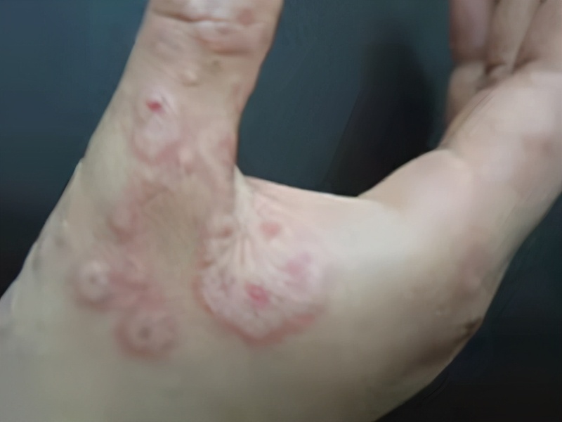 脖子上神经性皮炎的症状图片,只在脖子上起的疹是神经性皮炎吗