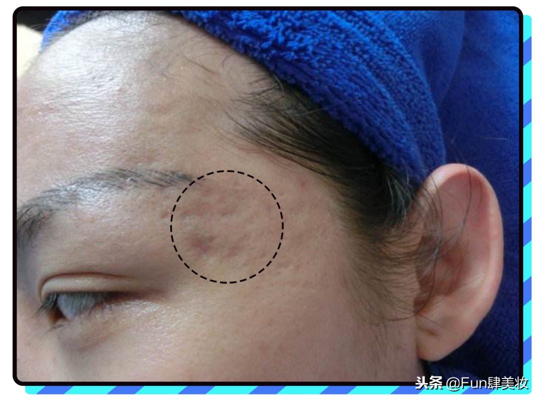 长痘怎么才能不留痘坑,痘肌自救方法视频