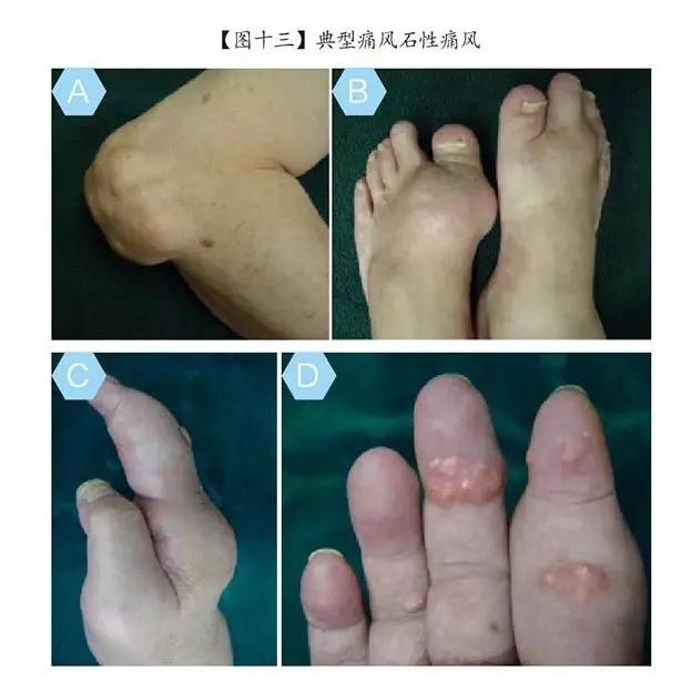 为什么我国痛风人数超过1亿,中国为什么这么多人得痛风