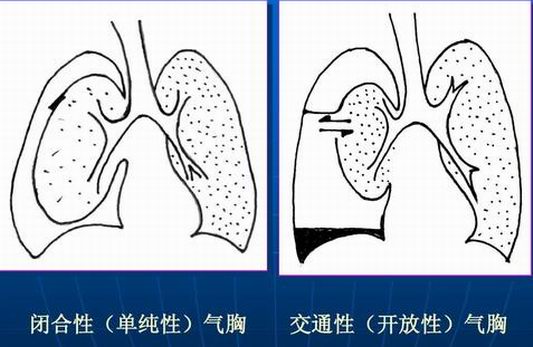 气胸什么情况下需要紧急处理,气胸引起的胸痛持续多久