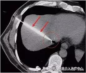 肝癌介入微创消融治疗,肝癌栓塞介入手术