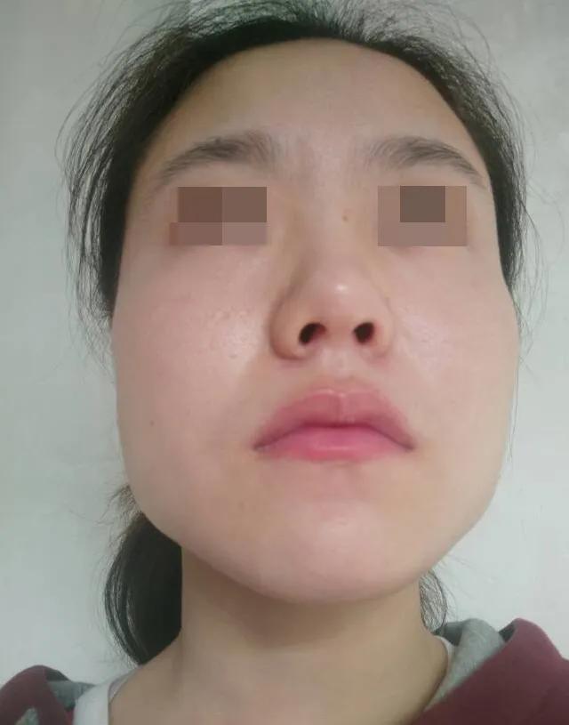 下颌宽大怎么办,下颌宽大导致方脸