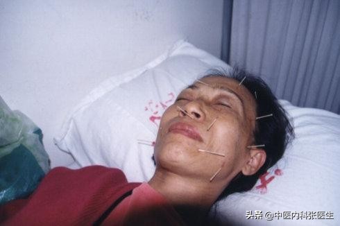 得了面瘫怎么用中草药治疗,得了面瘫怎样保健