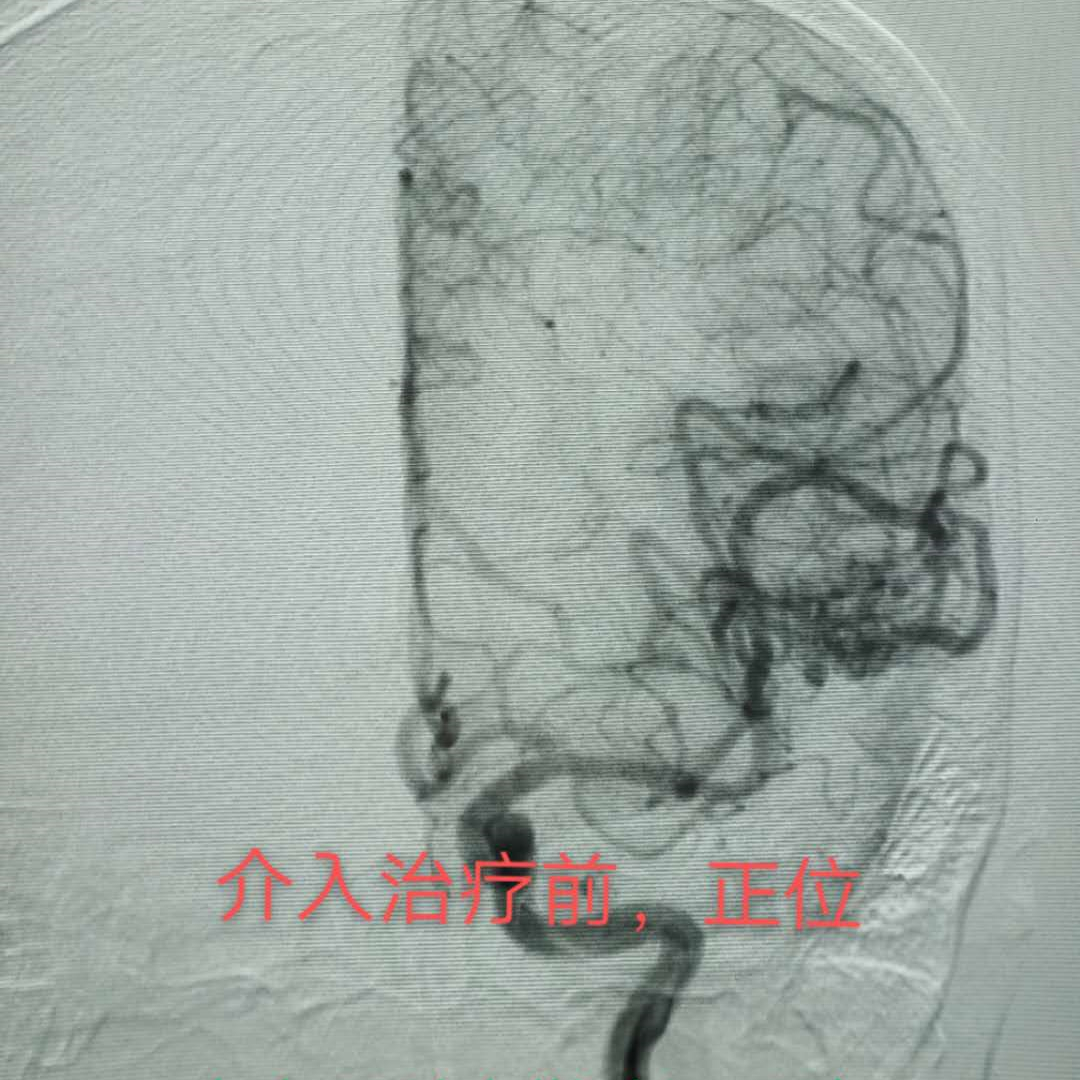 脑动静脉畸形可选用的栓塞物,脑动静脉畸形做伽玛刀后康复