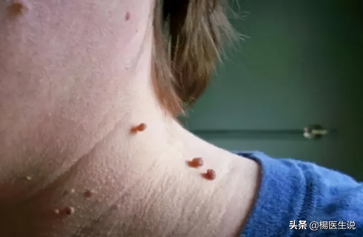 耳朵后面长了个肉瘤是怎么回事,耳朵上长了一个小肉瘤