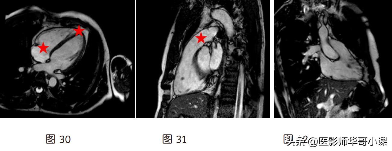 磁共振心脏扫描标准切面,心脏mri扫描定位