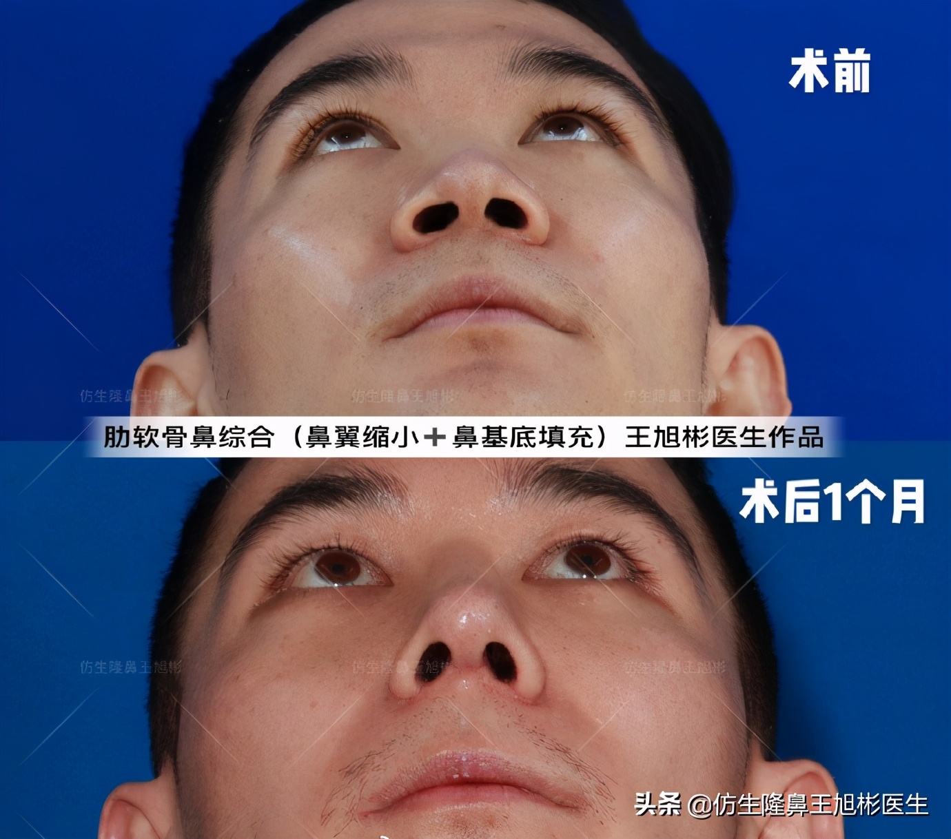 鼻头和鼻小柱是如何抬高的,鼻头扁是什么预兆