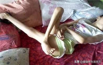 人体健康之运动神经元病,运动神经元病的锻炼方法