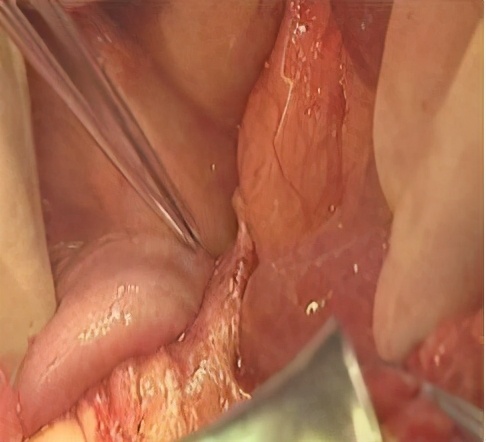 拉不出便便怎么办快速解决,拉不出便便怎么办吃什么能消化