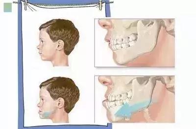 儿童牙齿早期干预矫正有几种,儿童牙齿早期矫正图片