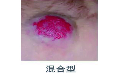 宝宝血管瘤破了应该怎么办,宝宝血管瘤破了怎么办