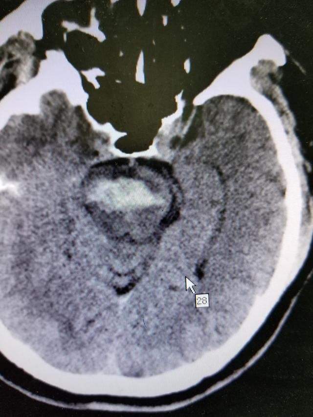最凶险的脑干出血几毫升也要命,医生提醒:做好5点就能远离它