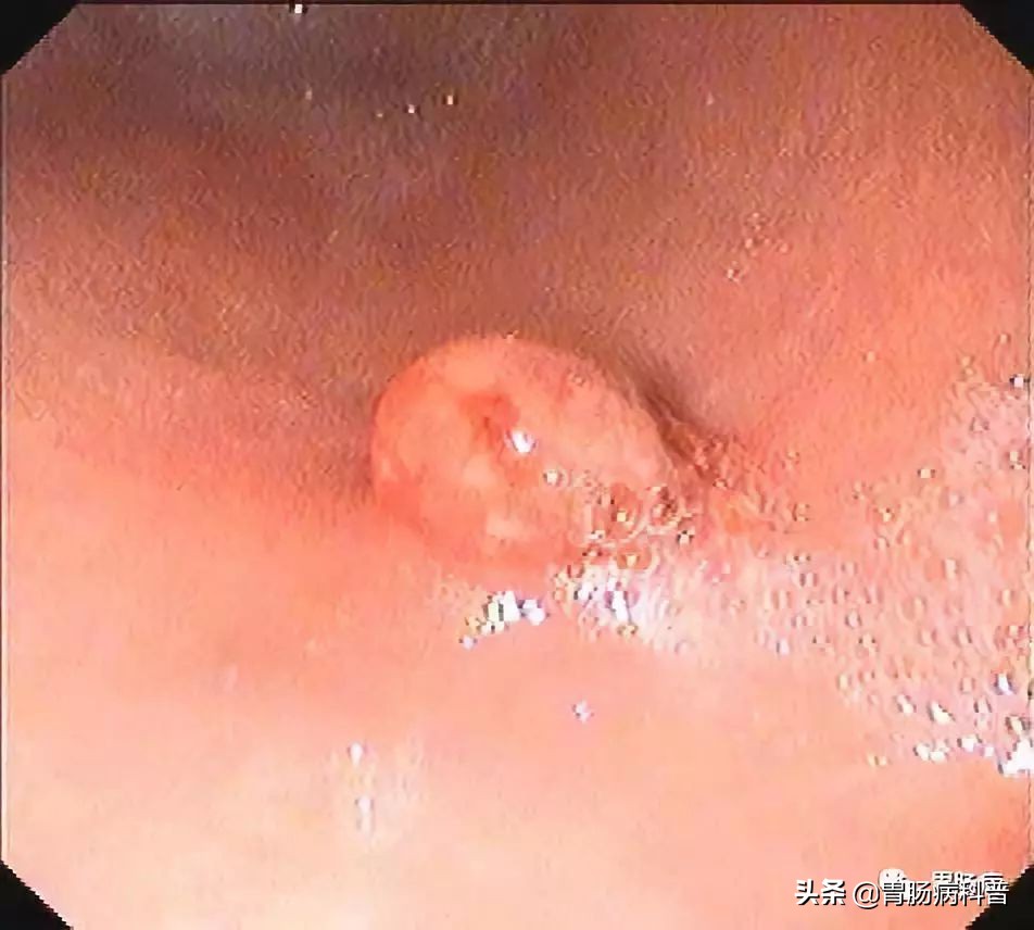 长胃息肉要注意什么,胃长息肉要注意什么