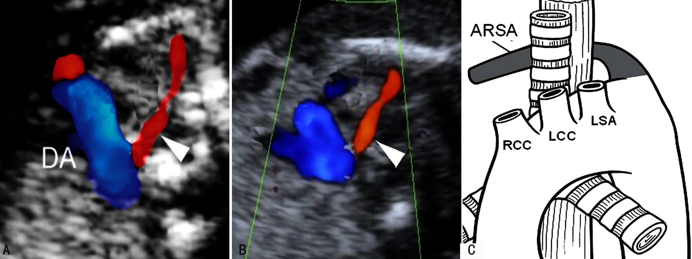 孕晚期胎儿染色体检查与基因检查,孕中期染色体异常超声指标