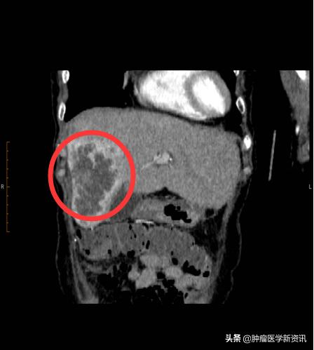 一位患者的真实抗癌经历,一位母亲的抗癌历程