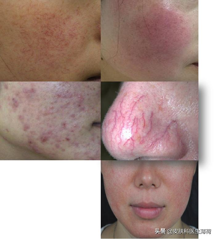 医美皮肤科医生介绍,医美小知识光子嫩肤