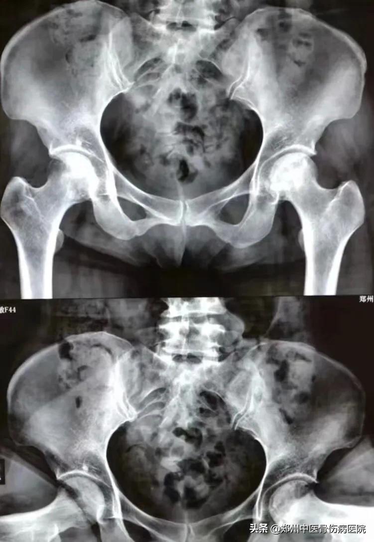 得了股骨头坏死应注意什么,得了股骨头坏死该怎么治疗