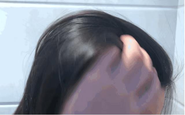 去头屑去螨虫哪个洗发水最有效,去头屑去螨虫用哪个洗发水最有效