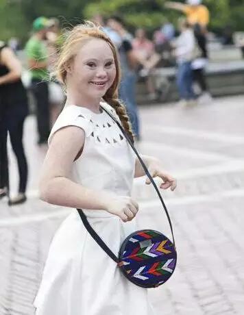 唐氏综合征中国美女,患有唐氏综合征的维密模特