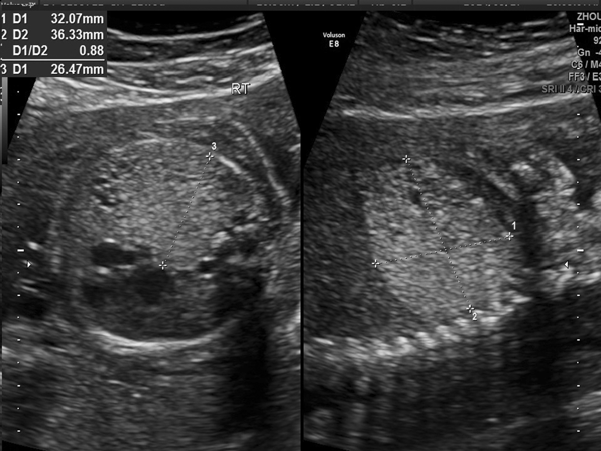 超声检查可以看到胎儿肺部吗,针对性胎儿心脏超声检查