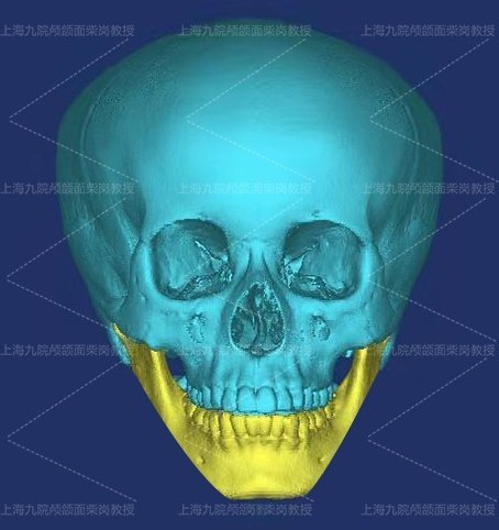 颧骨和下颌角有没有必要一起做,颧骨高割下颌角会老得快吗