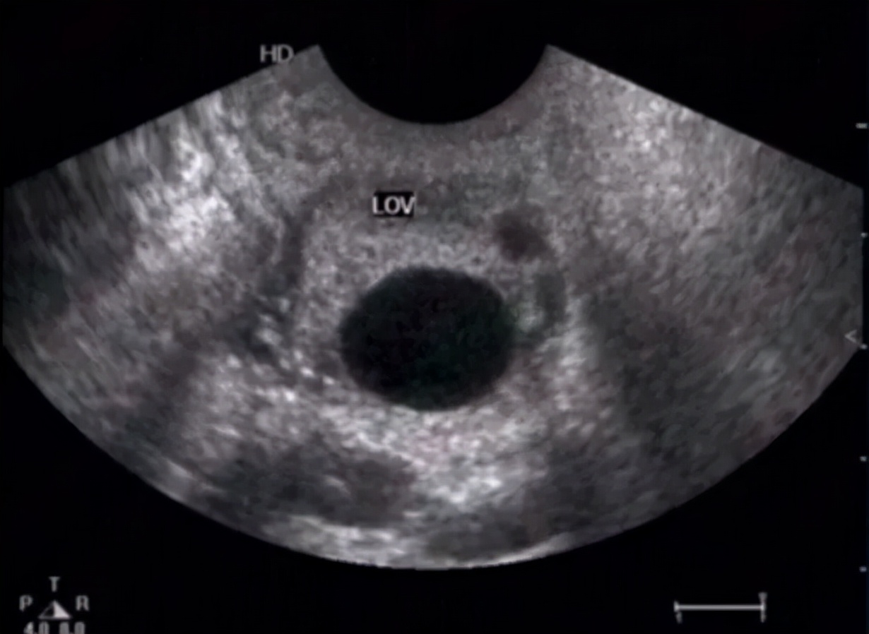 体检卵巢有个囊肿要紧不要紧,体检卵巢囊肿什么原因