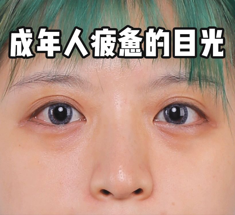 花了10800块去黑眼圈没效果,网上治疗黑眼圈靠谱么