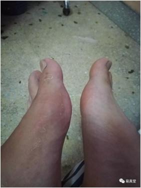 中医治疗痛风的有效方法,中医治疗痛风的思路是什么