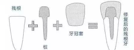 根管治疗后牙齿劈裂怎么办最好,戴冠后牙会不会劈裂