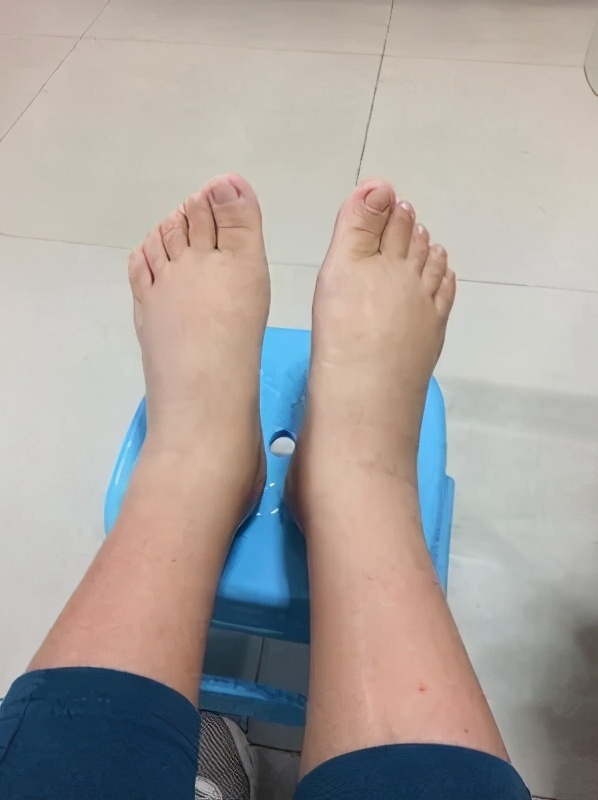 23岁女孩患甲亢的真实案例,孩子一岁三个月妈妈检查出甲亢