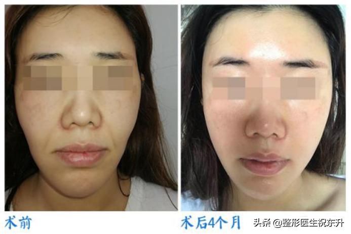 30岁脸部松垮下垂要做拉皮吗,35岁面部松弛怎么办