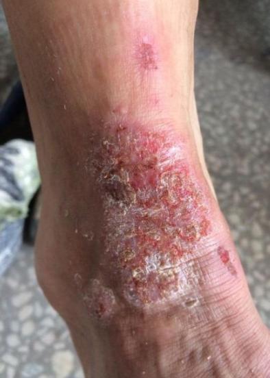 有哪些药膏可以有效地止痒？