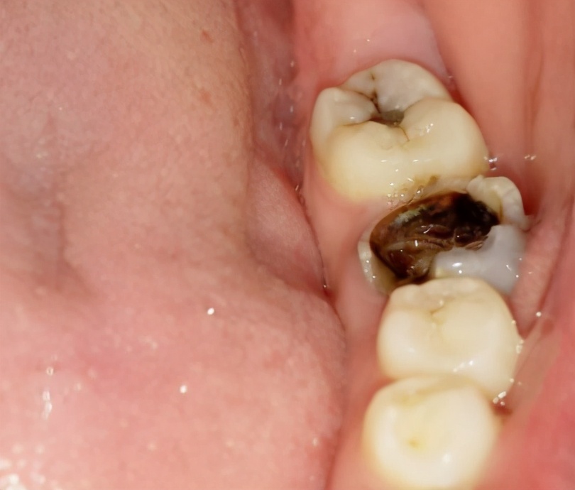 有效改善牙龈出血的5个技巧,有什么好的方法治疗牙龈出血呢