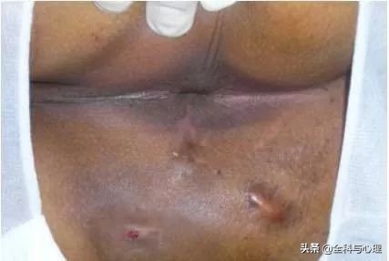 肛门有肿块是什么症状,肛门有哪些病变会痒