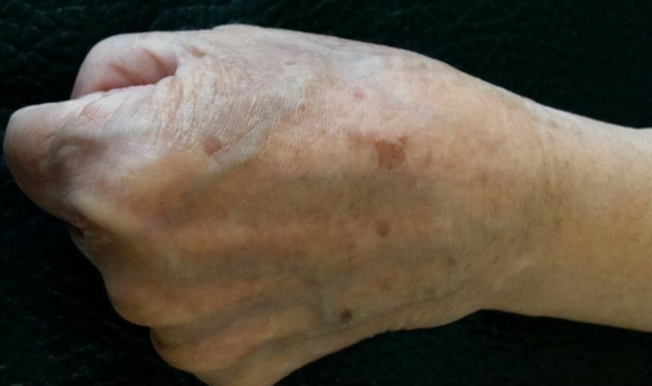 艾滋病窗口期会出现皮肤几种症状,艾滋病前期一定会出现皮肤问题吗