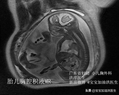 还没生就流虚汗,胸腔里有积水是怎么回事