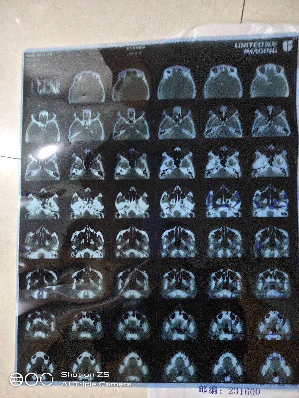 拔牙时发现牙根有个脓包,拔牙拍片发现上颌有个囊肿