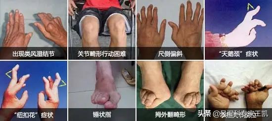 类风湿关节炎已畸形如何止痛,类风湿性关节炎关节畸形护理措施