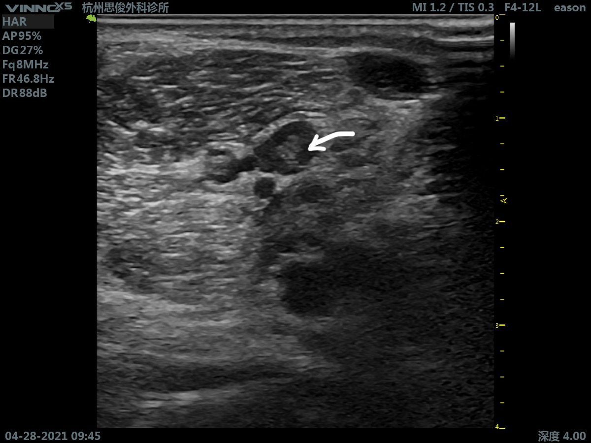 小腿深静脉血栓多久才可以痊愈,深静脉血栓形成的诊断和治疗指南