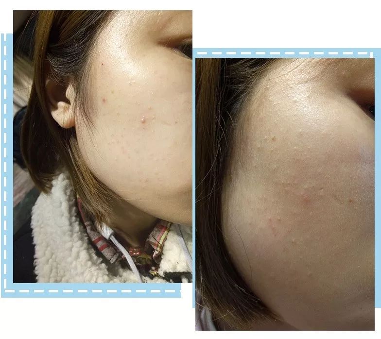 教你快速消灭脸上闭口型痘痘,实用的祛痘痘方法