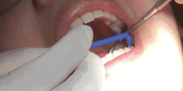 宝宝牙齿还能用护牙素吗,宝宝牙齿防护