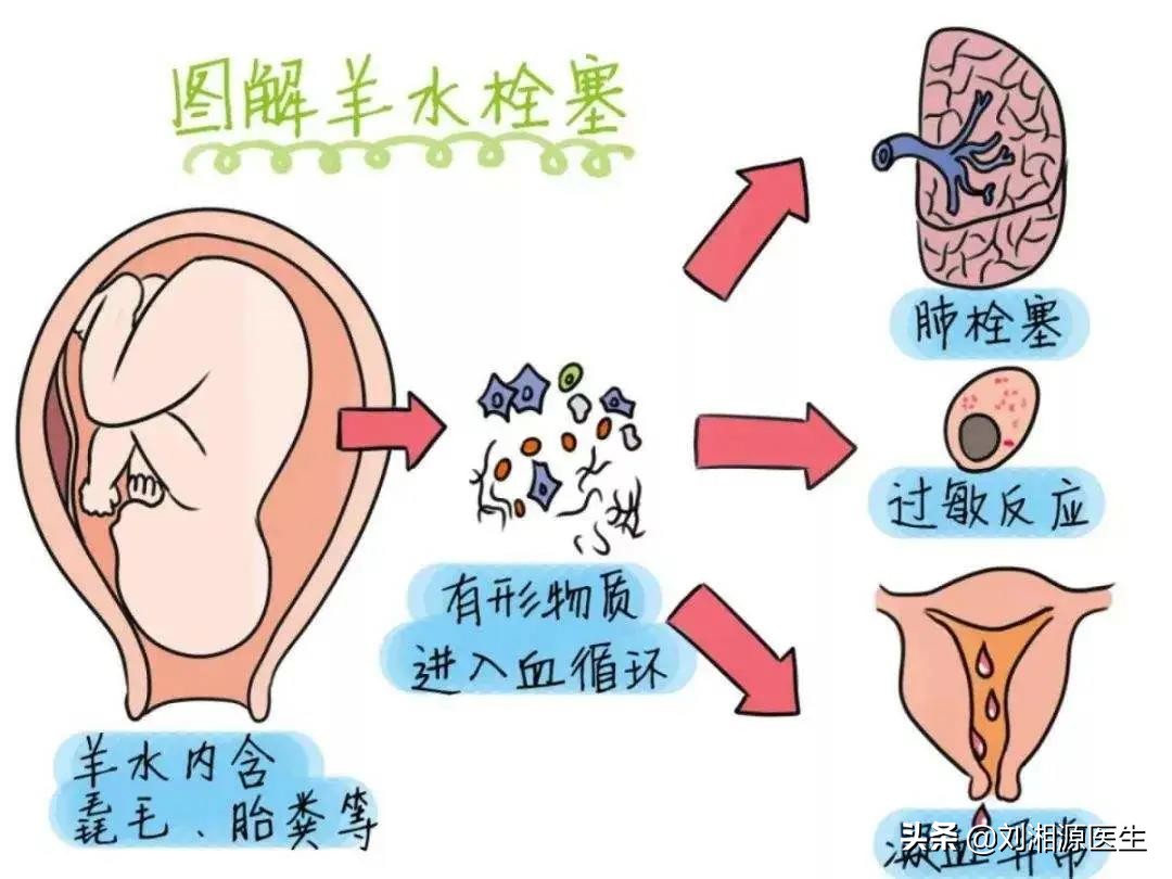 「免疫相关不良妊娠答疑解惑62」——分娩