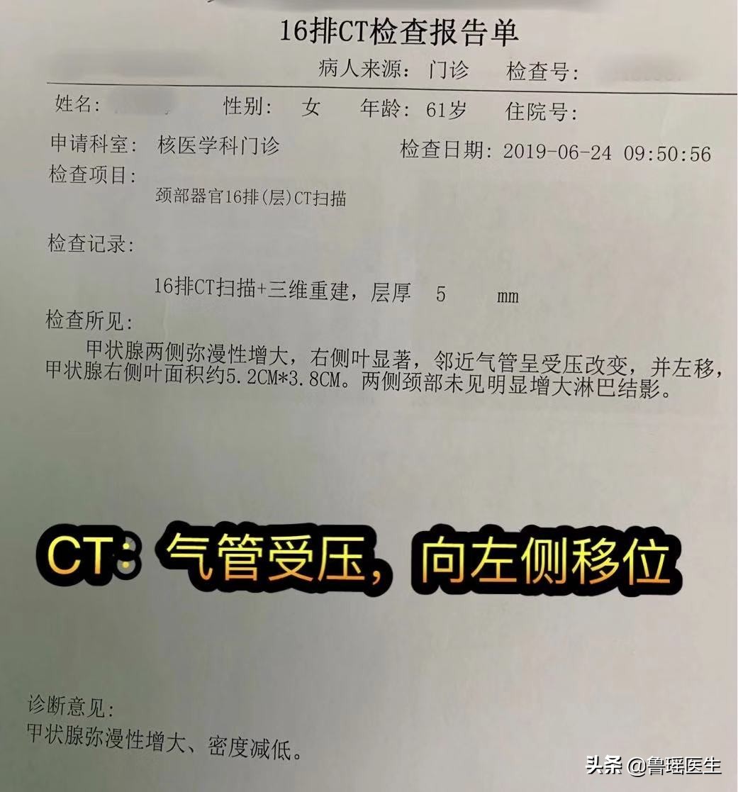 病例分享：桥本氏甲状腺炎是一种什么病？需要手术吗？